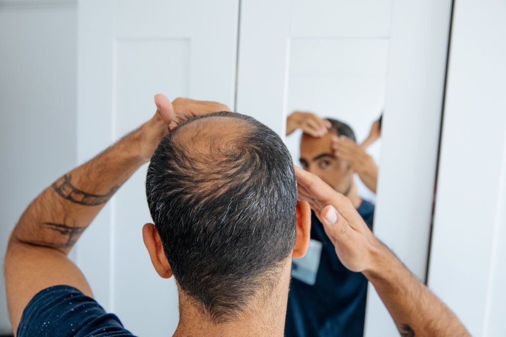 Conseils et astuces pour traiter la chute de cheveux chez les hommes ?
